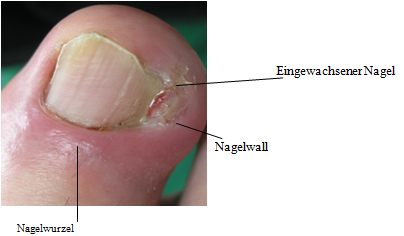 Nagelbett entzündetes Nagelbettentzündung »